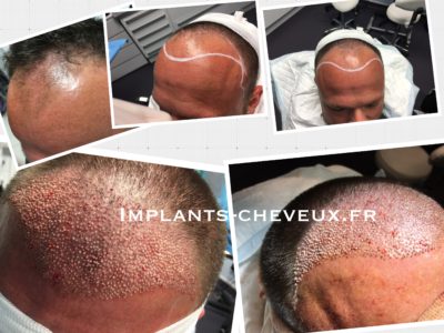 correction ligne frontale et vertex